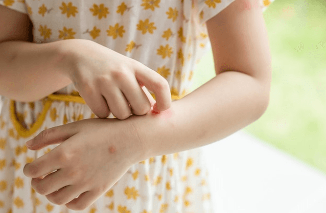 Treating Eczema - Nature's Source Inc